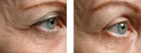 image thermage-eyes-before-and-after-1-jpg