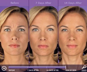 Botox: before and after photos - patient 1