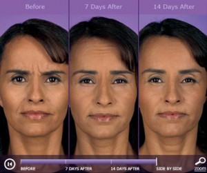 Botox: before and after photos - patient 2
