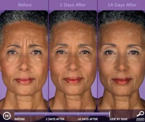 Botox: before and after photos - patient 3