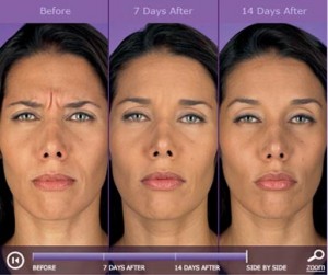 Botox: before and after photos - patient 4
