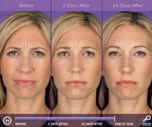 Botox: before and after photos - patient 6